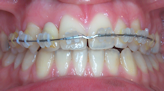 Le traitement en Orthodontie Brétigny-Sur-Orge